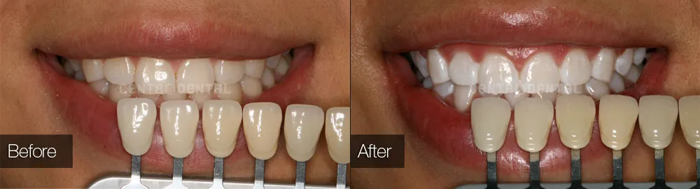 32999 teeth whitening results