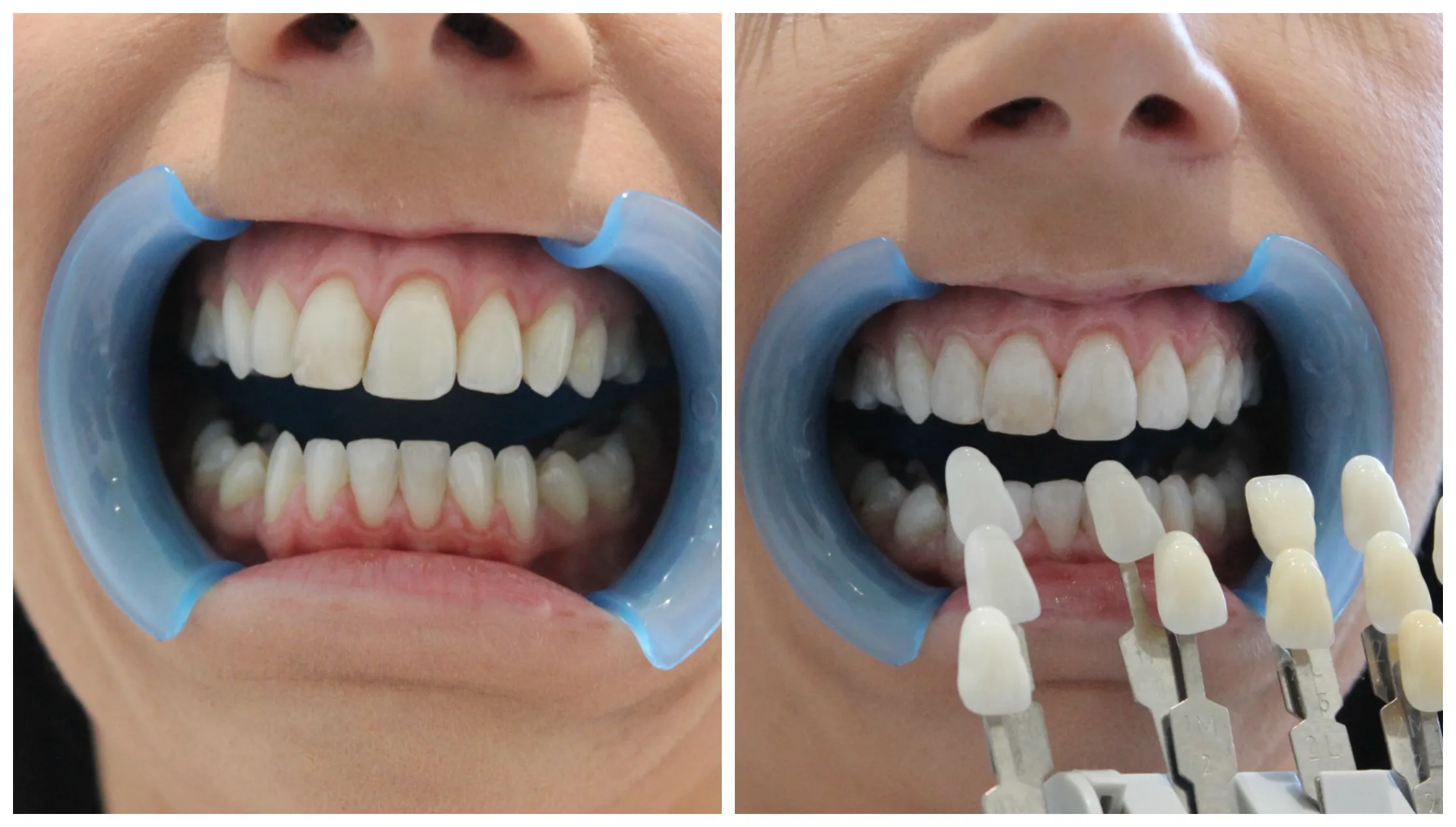 33004 teeth whitening options