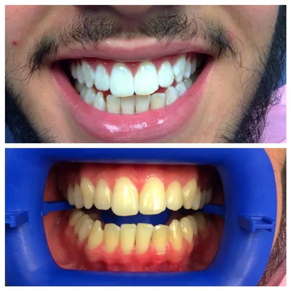 33004 teeth whitening results