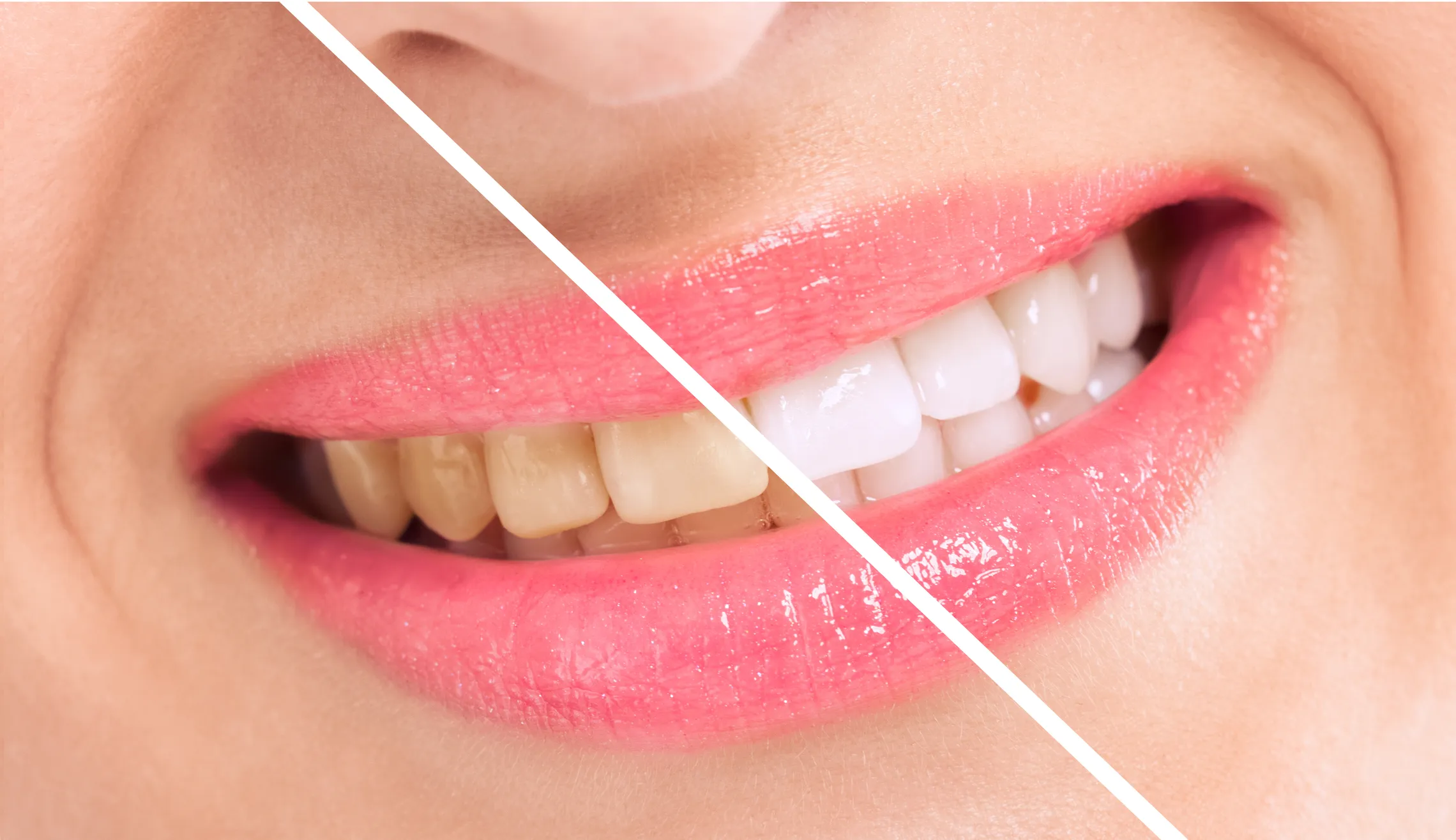 33009 at home teeth whitening