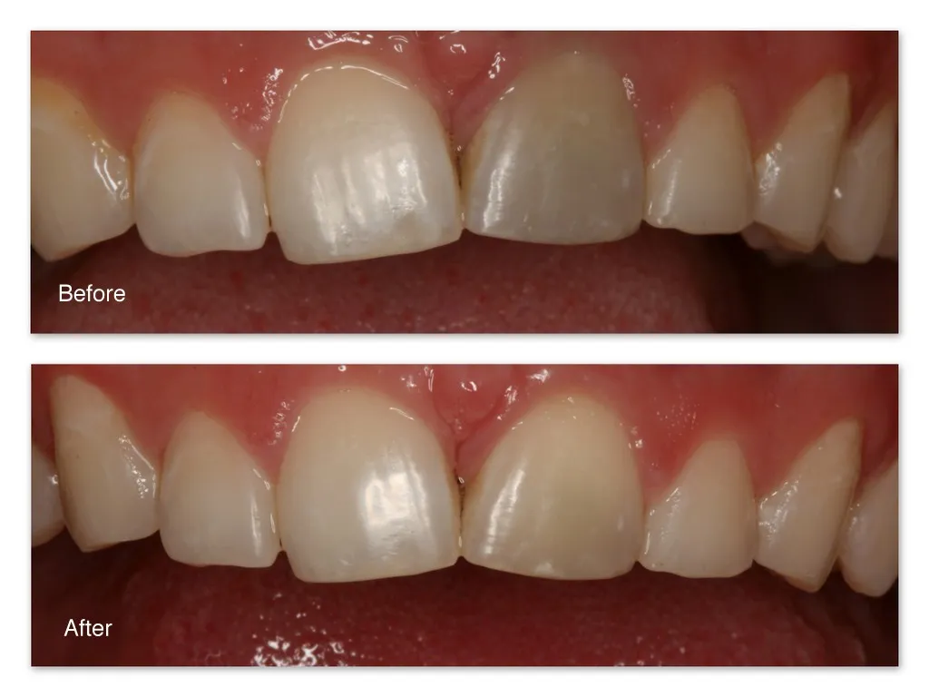 33009 types of tooth whitening