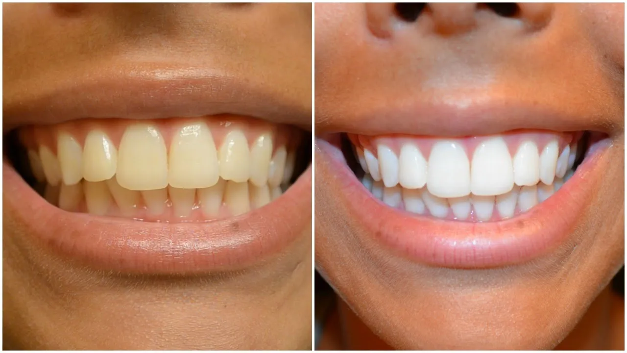 33010 applying whitening strips