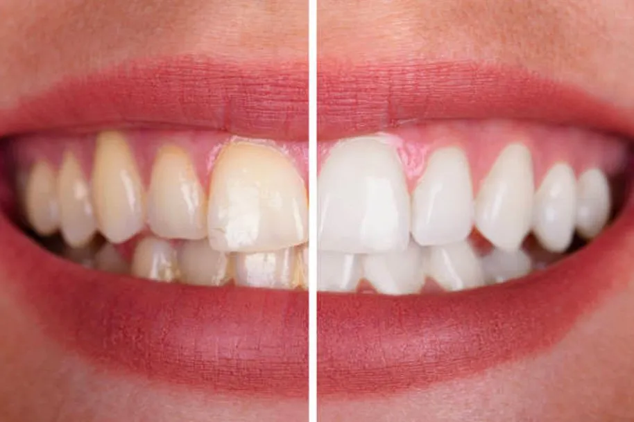 33011 sensitive teeth