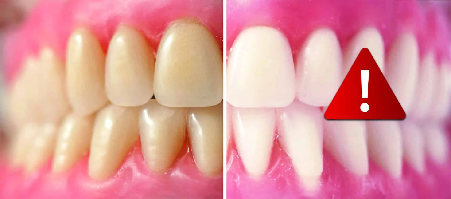 33017 teeth whitening gums image3