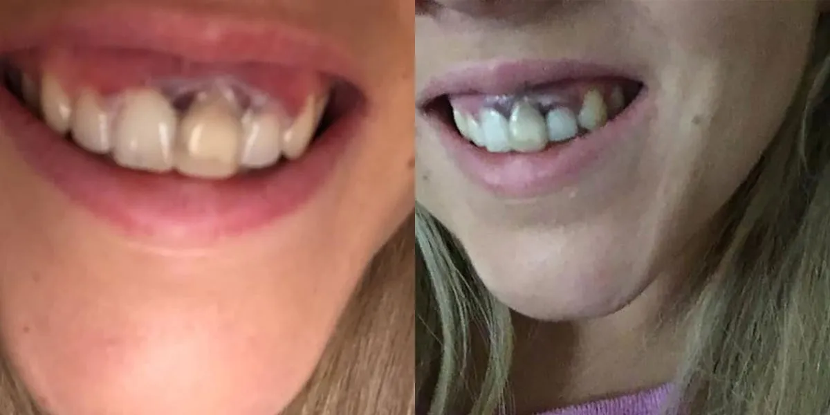 33017 teeth whitening gums image4