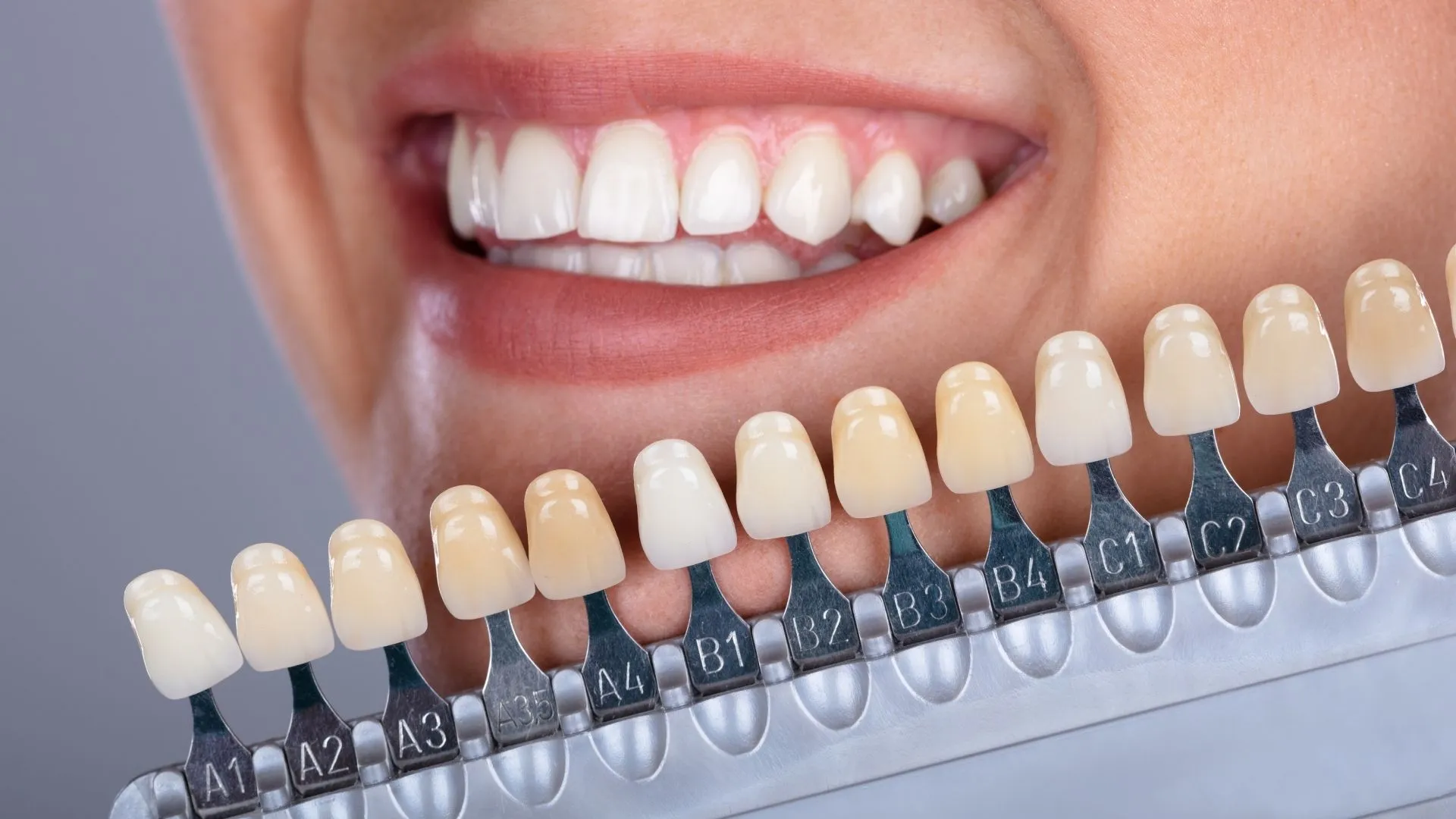 33017 teeth whitening gums image5