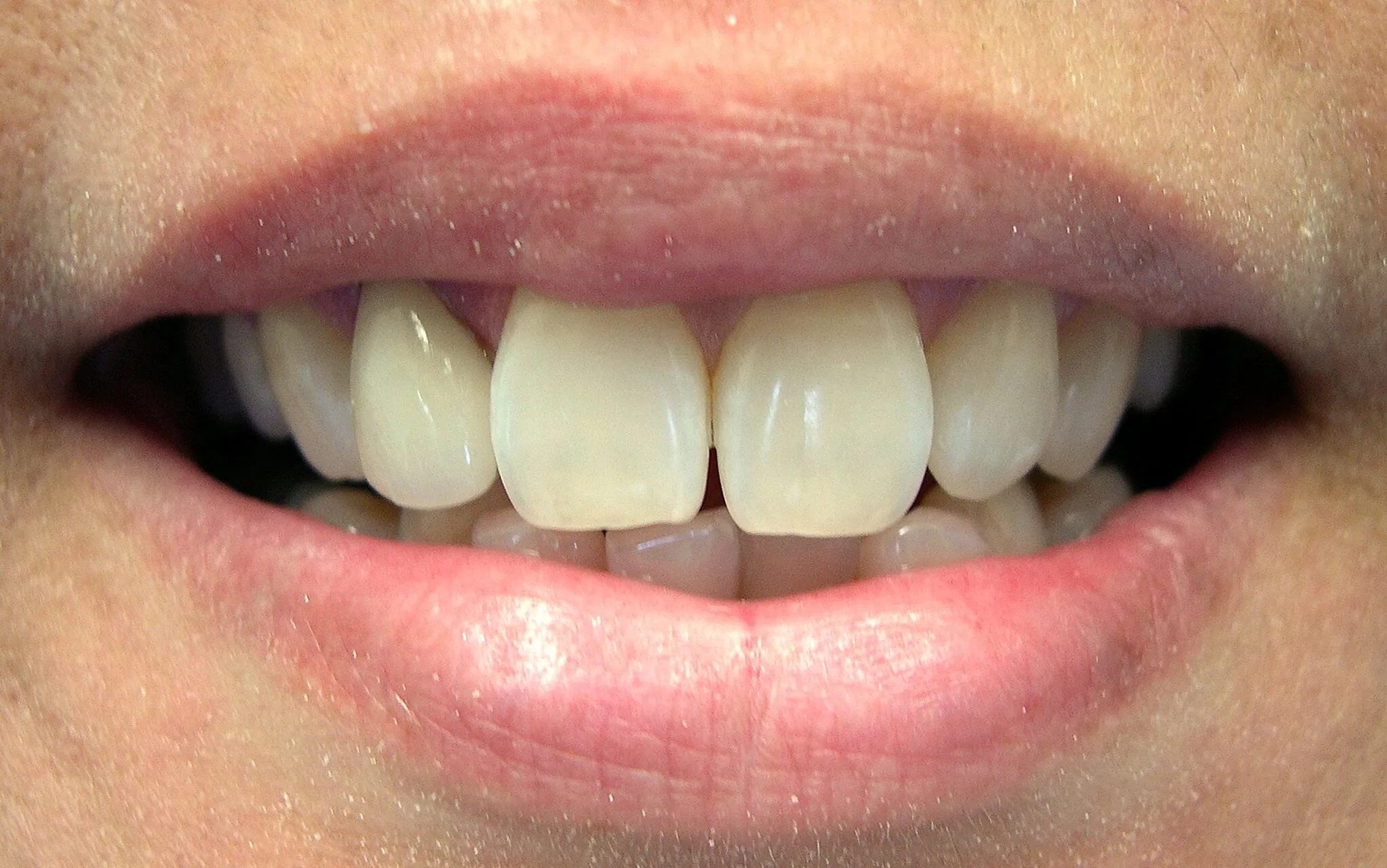 /img/33017-teeth-whitening-gums-image7.webp