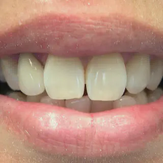 /img/33017-teeth-whitening-gums-image7.webp