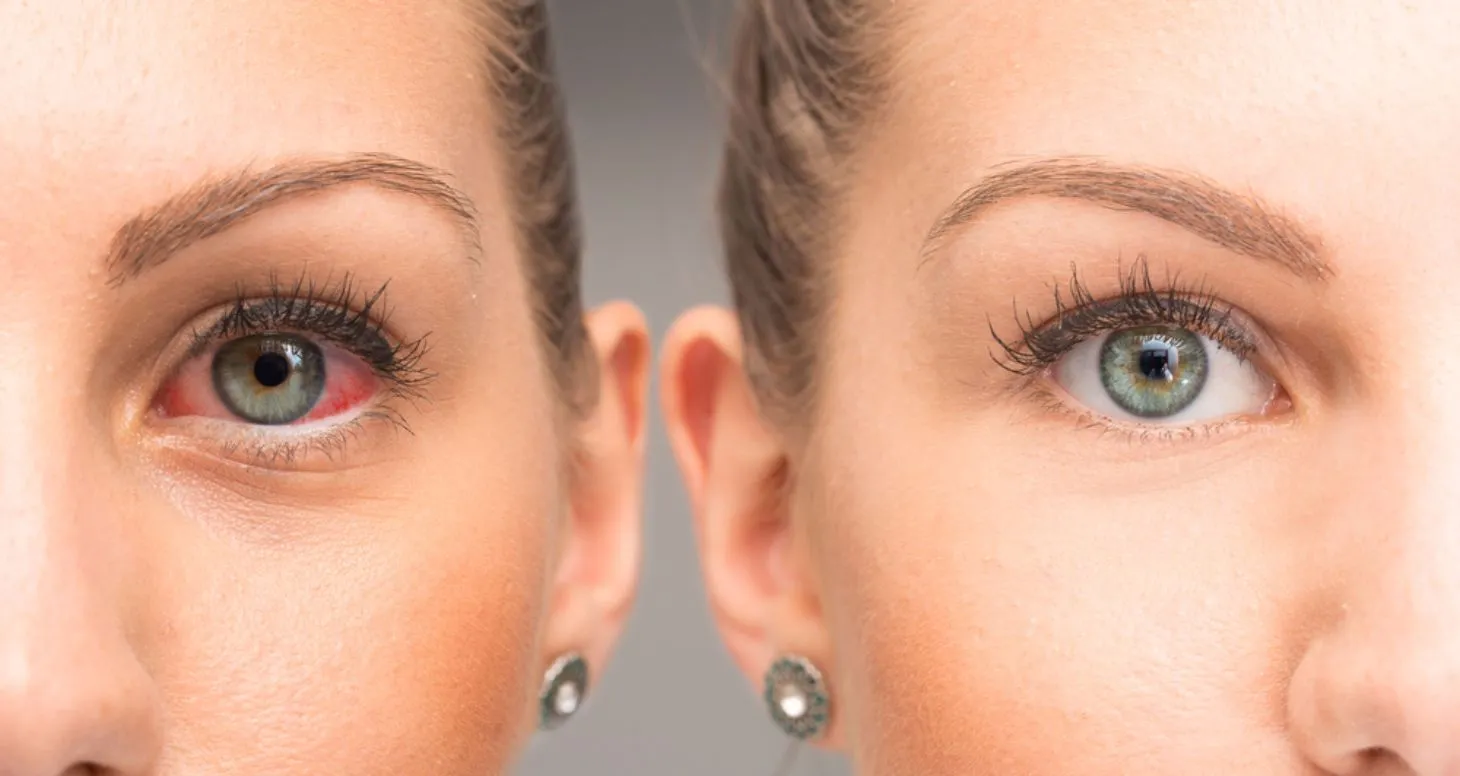 33019 red eyes causes