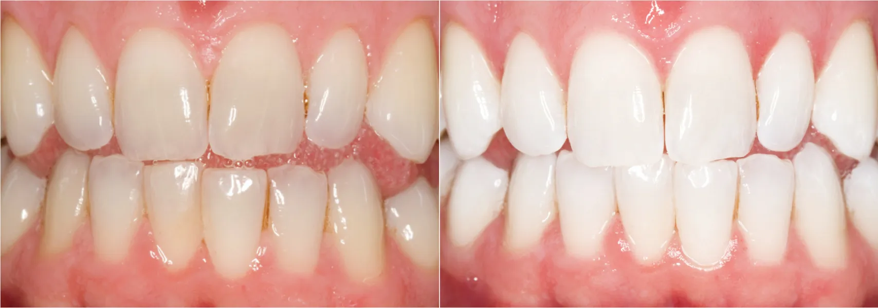 33026 opalescence whitening at home