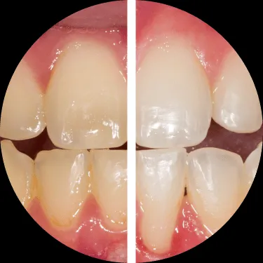 33026 opalescence whitening confidence