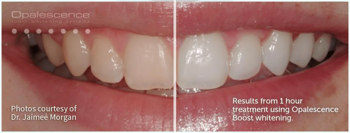 33026 opalescence whitening professional