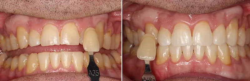 33026 opalescence whitening sensitivity