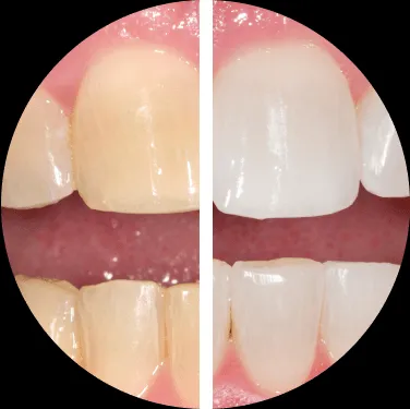 /img/33026-opalescence-whitening-smiling.webp