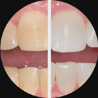 /img/33026-opalescence-whitening-smiling.webp