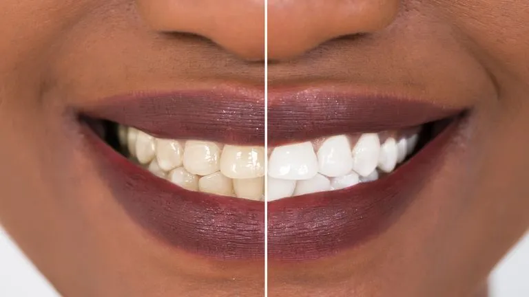 33032 teeth whitening enamel 4
