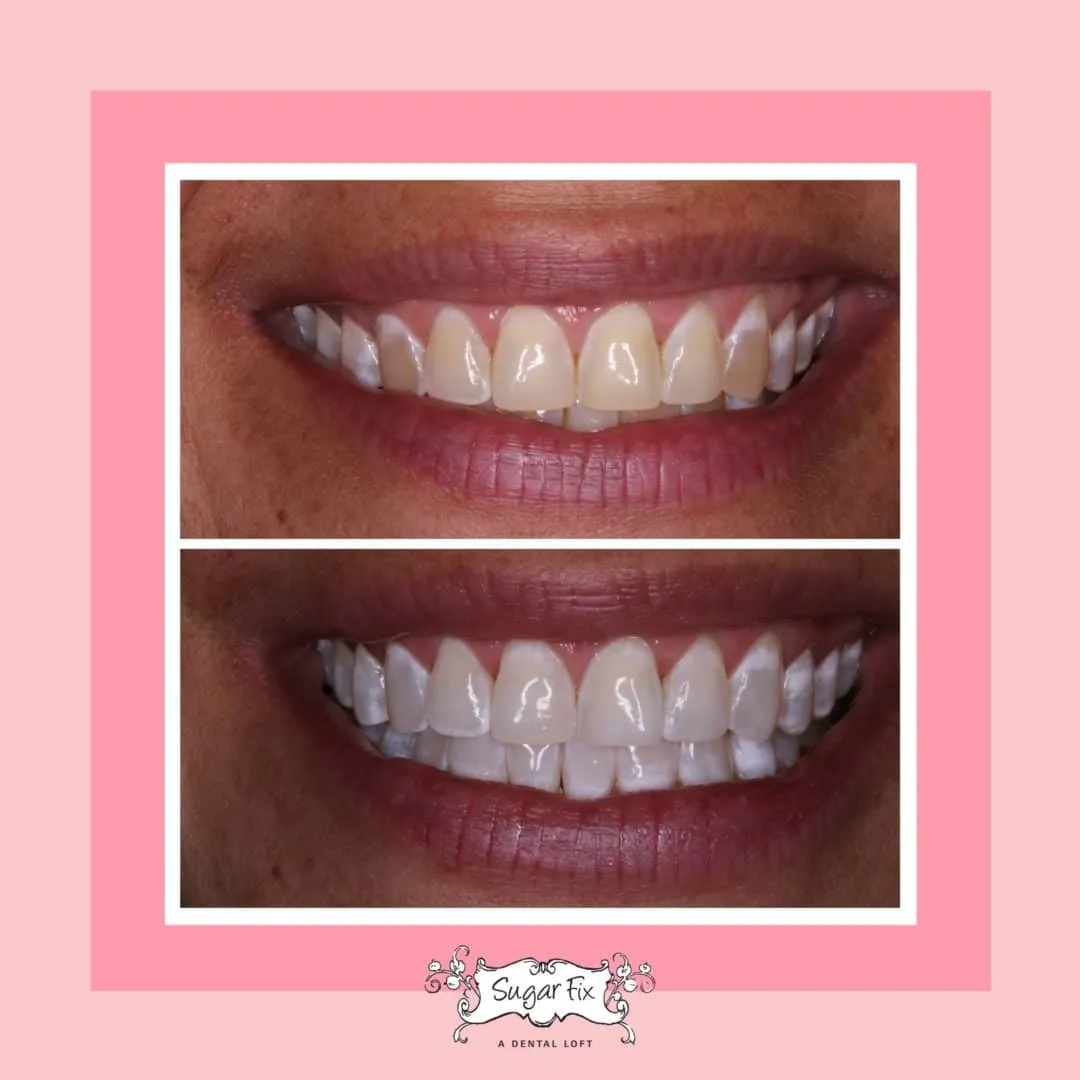 33033 stained teeth causes