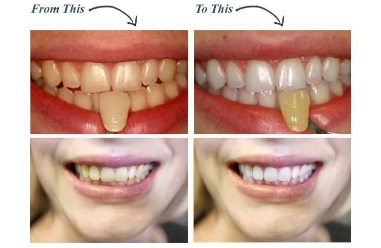 33034 teeth whitening consultation