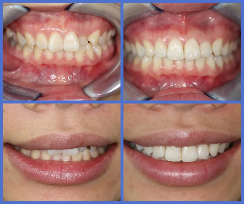 33035 teeth whitening and straightening image2