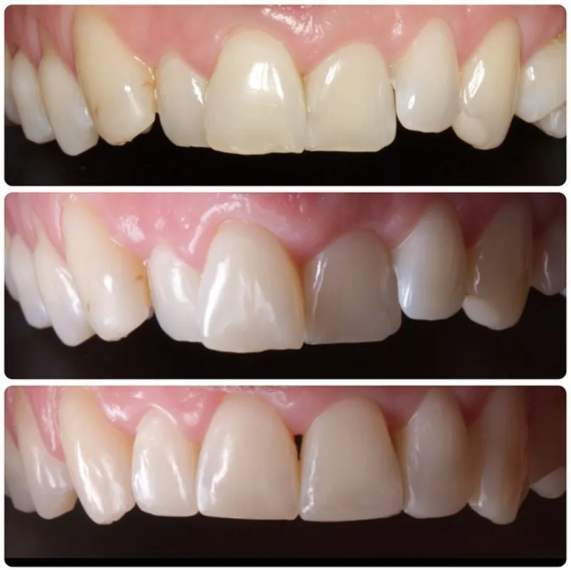 33035 teeth whitening and straightening image4