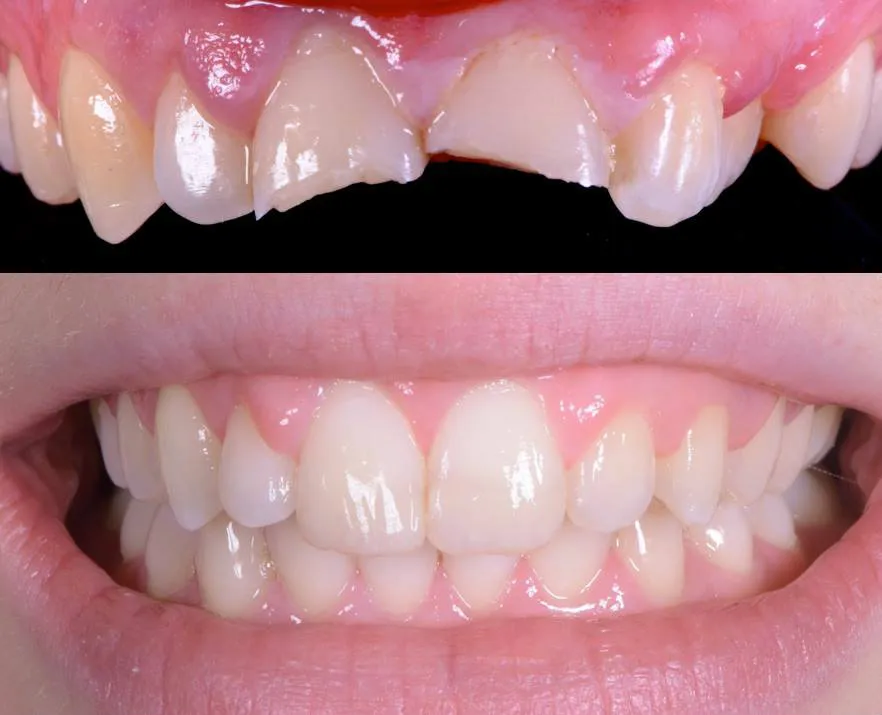 33035 teeth whitening and straightening image5