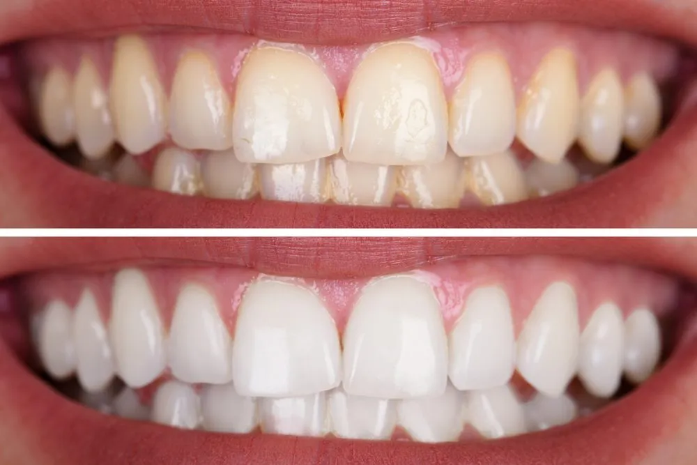 33035 teeth whitening and straightening image6