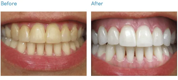 33036 groupon teeth whitening