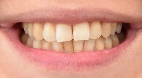 33036 teeth whitening comparison