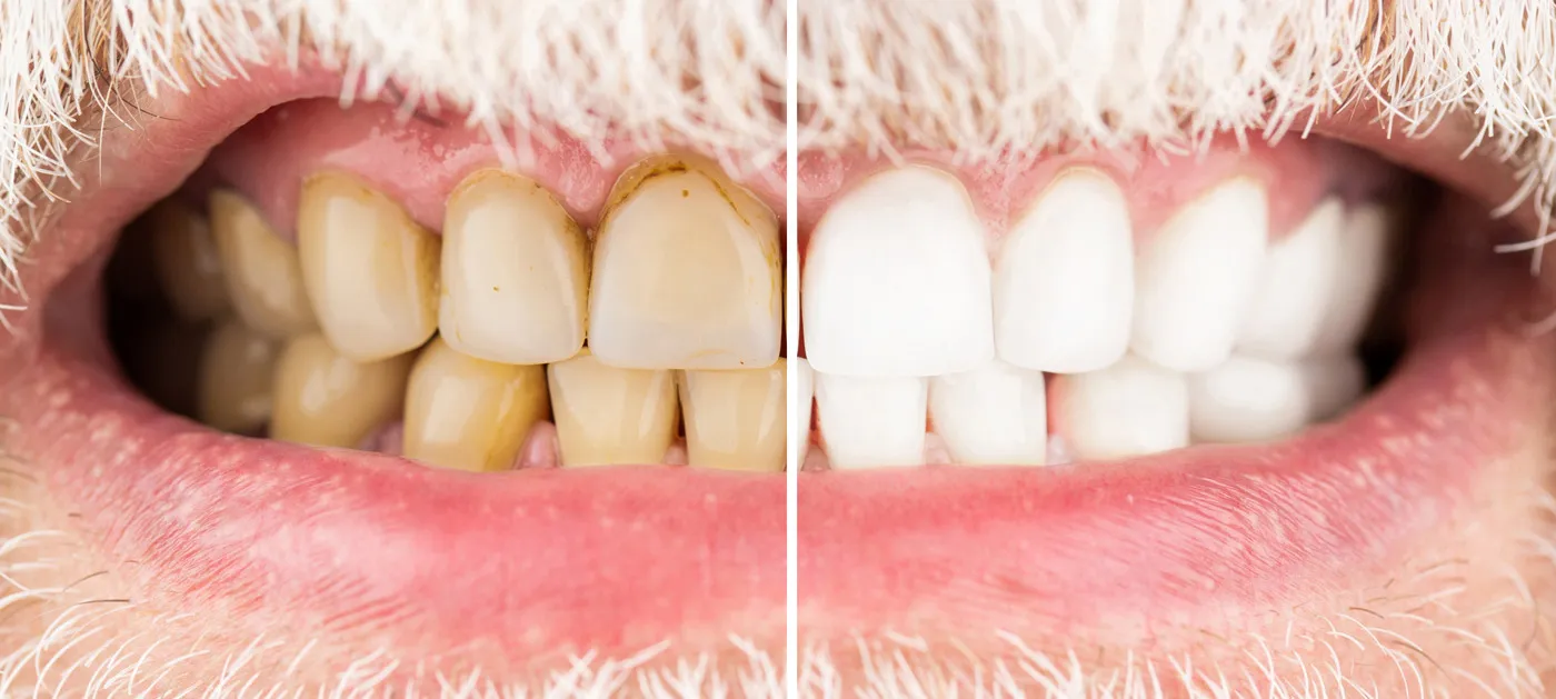 33038 foods to avoid teeth whitening