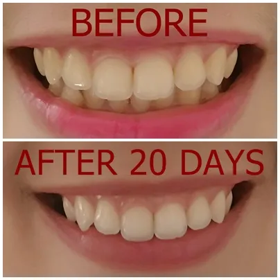 33040 gentle brushing technique