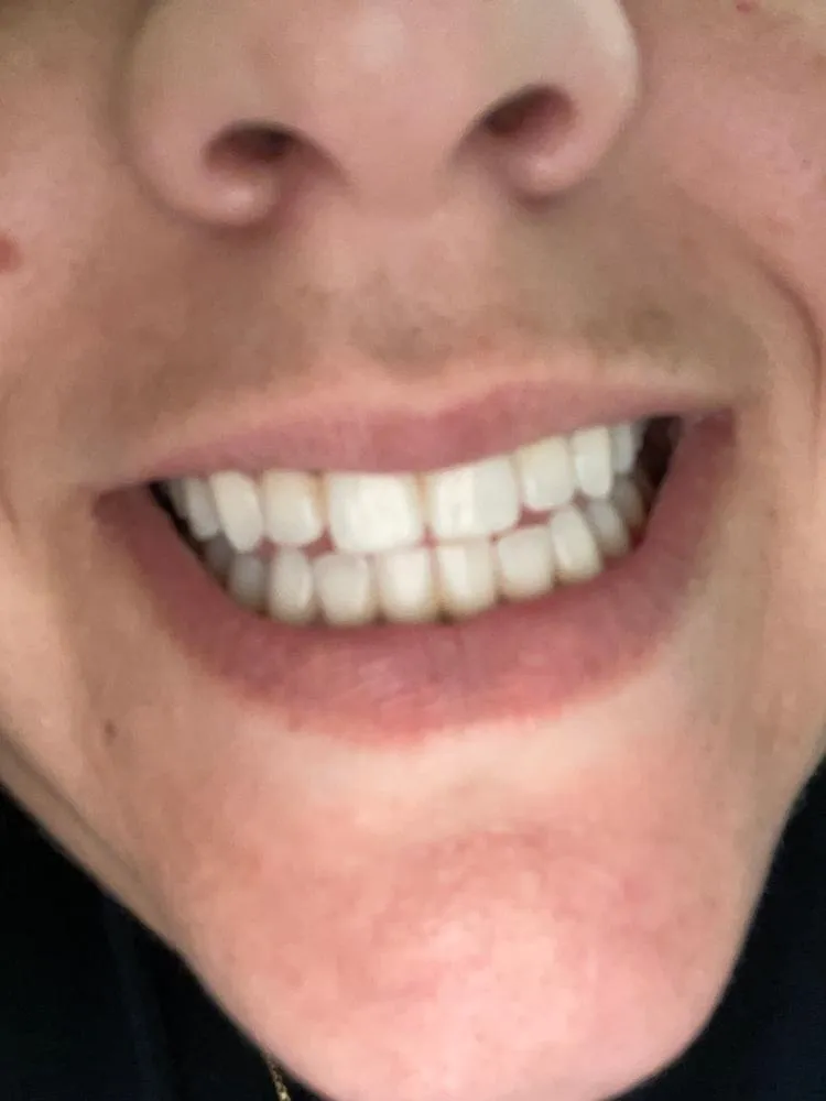 /img/33041-platinum-white-smile.webp