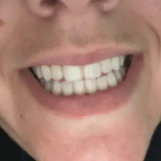 /img/33041-platinum-white-smile.webp