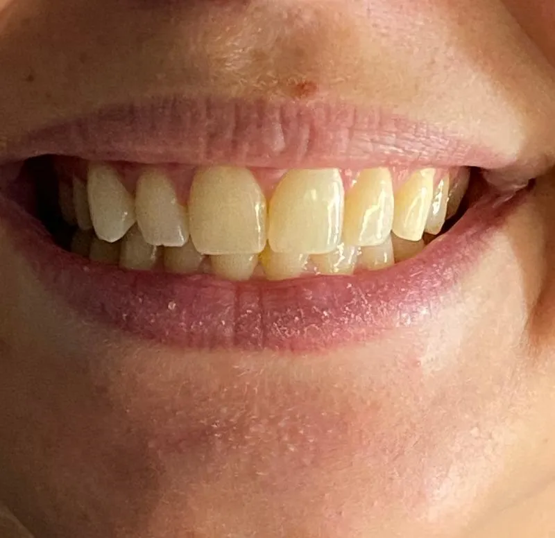 33041 teeth whitening application