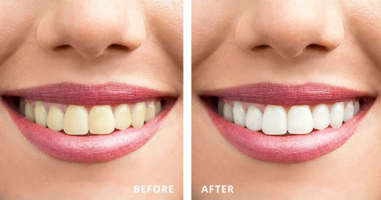 33042 at home teeth whitening kits