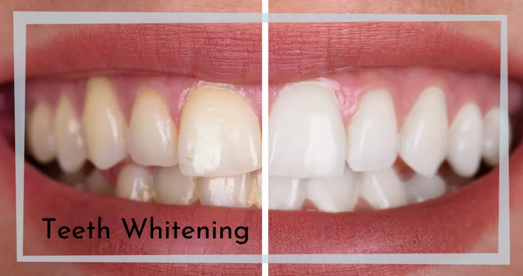 33042 types of teeth whitening