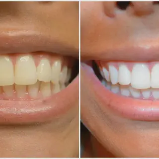 /img/33043-at-home-whitening-options.webp