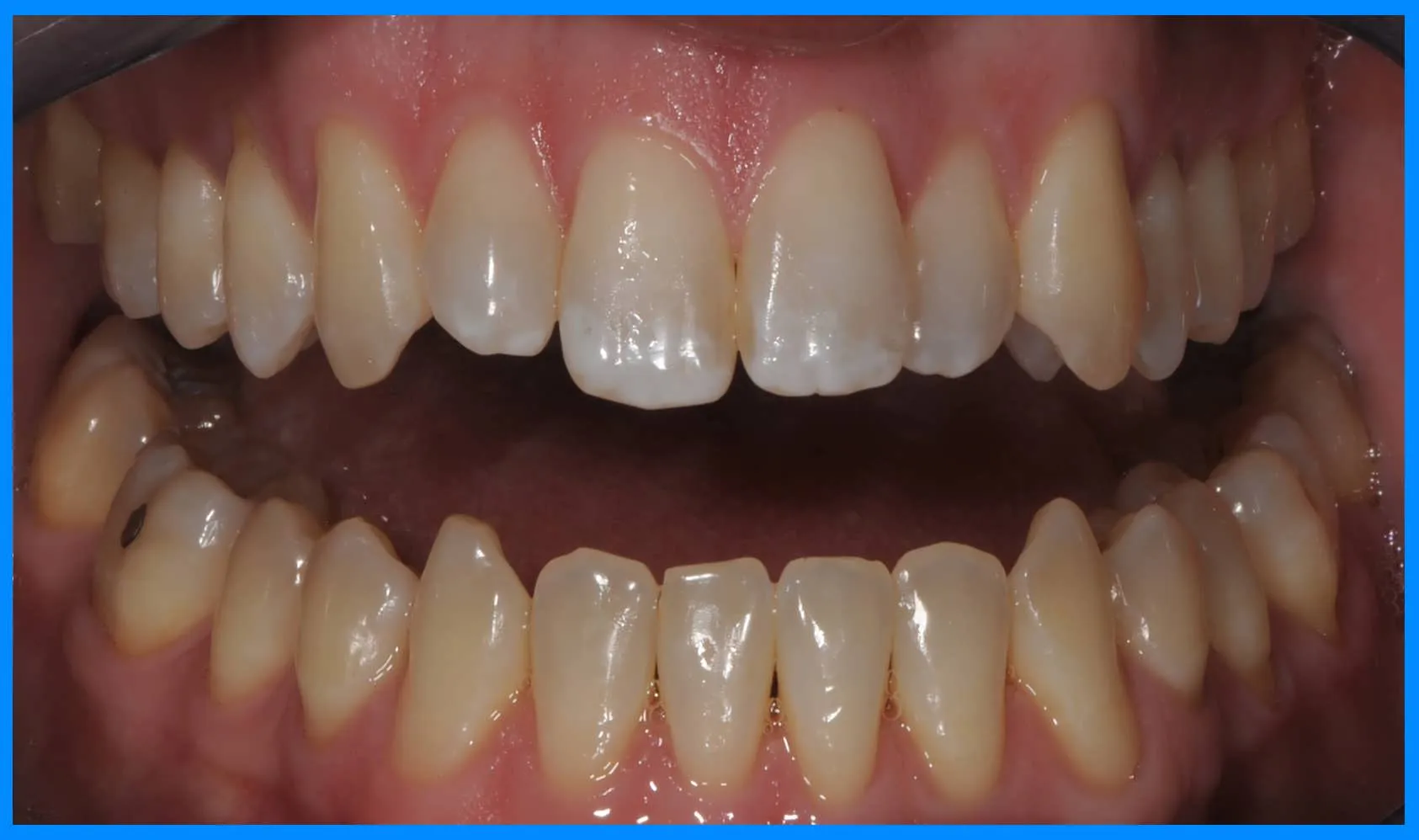 33054 houston zoom whitening teeth