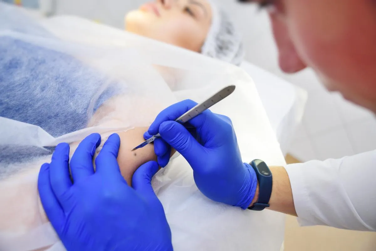 33058 laser skin resurfacing