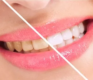33060 at home teeth whitening kits