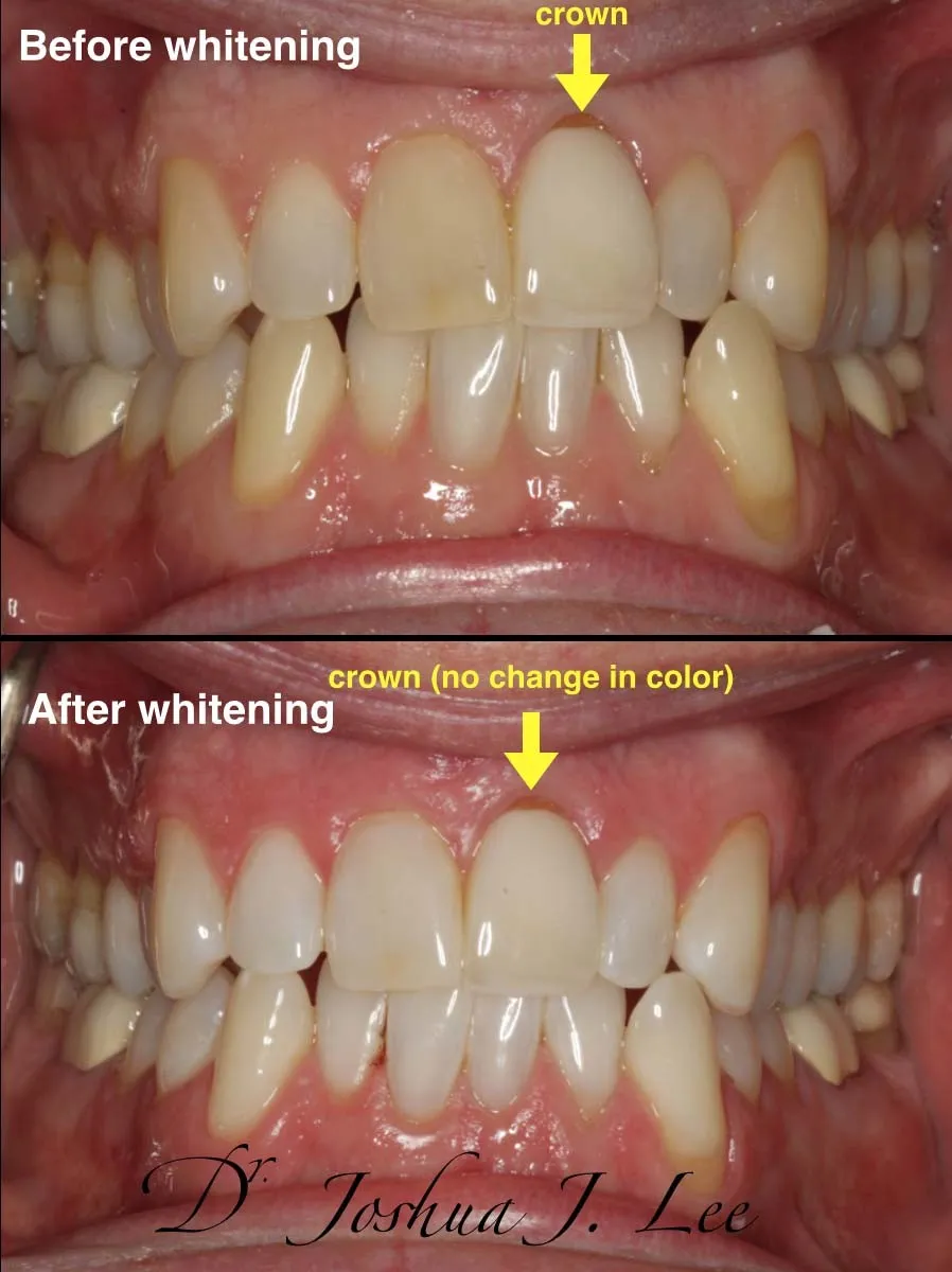 33064 zoom whitening frisco before after