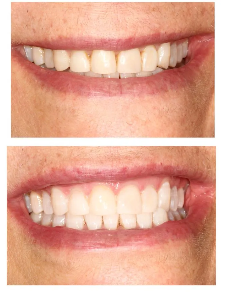 /img/33064-zoom-whitening-frisco-maintenance.webp