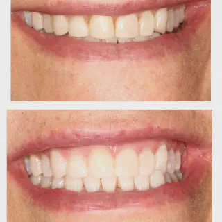 /img/33064-zoom-whitening-frisco-maintenance.webp