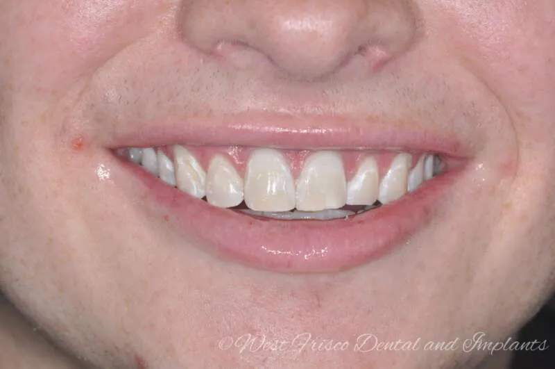 33064 zoom whitening frisco procedure