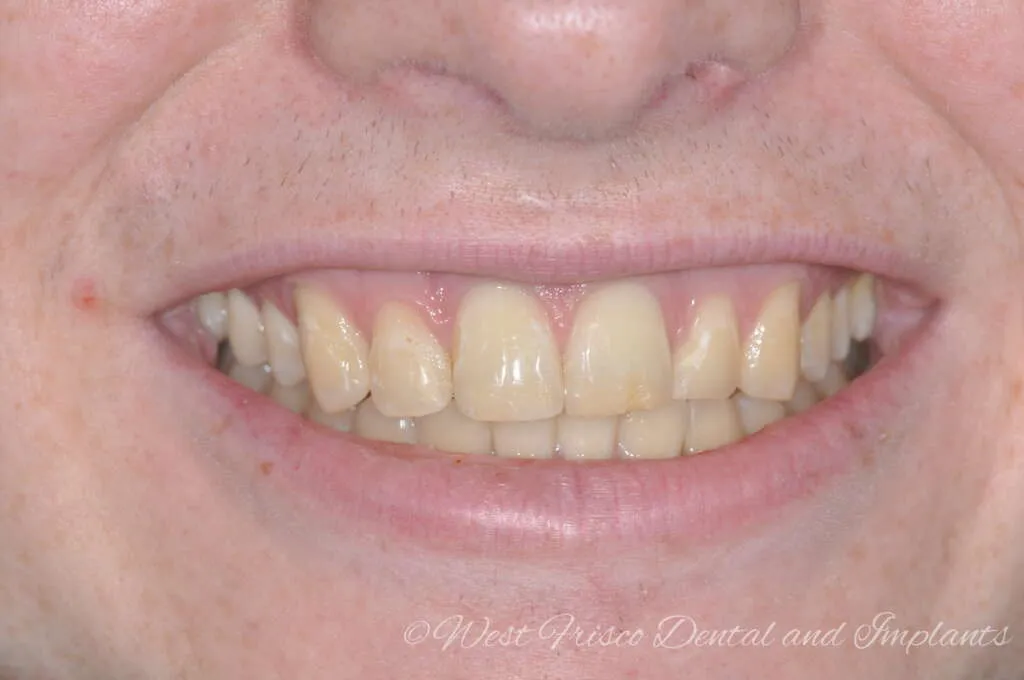 33064 zoom whitening frisco smile