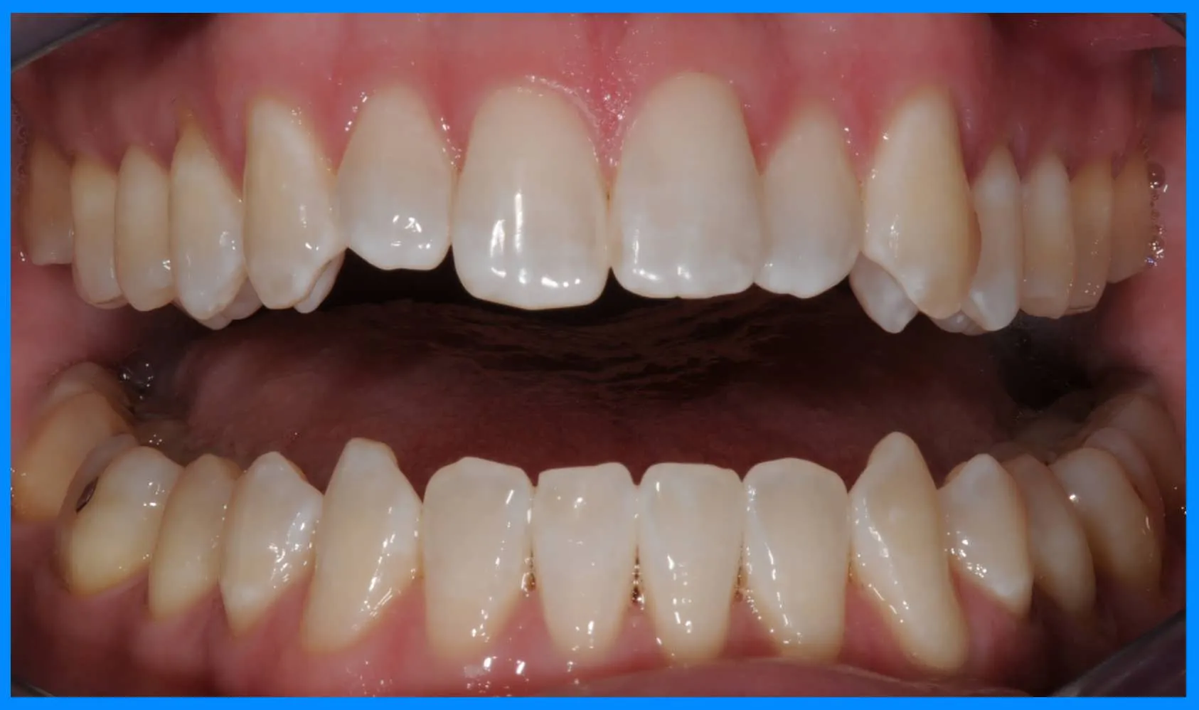 33064 zoom whitening frisco teeth