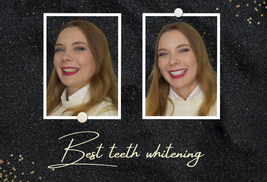 33068 teeth whitening kits