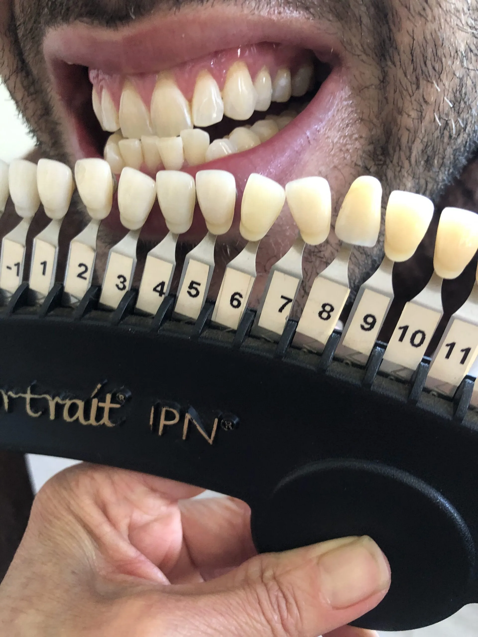/img/33070-teeth-whitening-before-after.webp