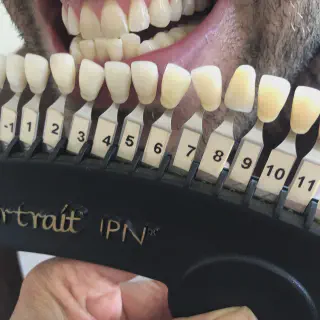 /img/33070-teeth-whitening-before-after.webp
