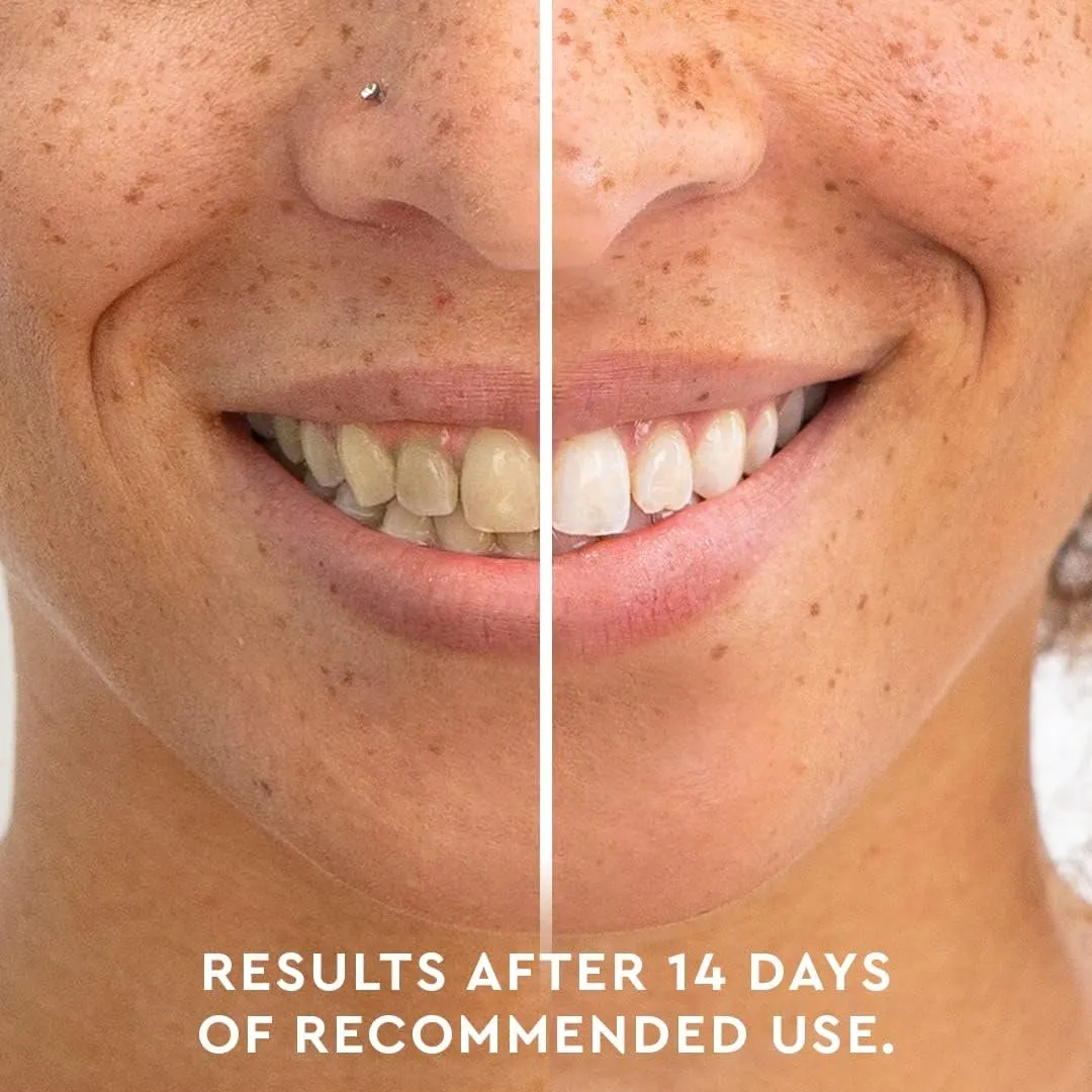 /img/33075-common-teeth-whitening-mistakes.webp