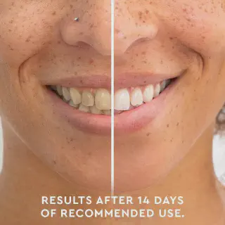 /img/33075-common-teeth-whitening-mistakes.webp